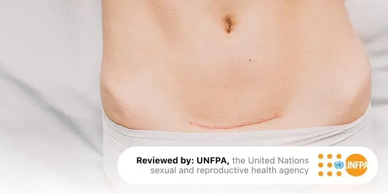 Having a C-section does not make you less of a mother