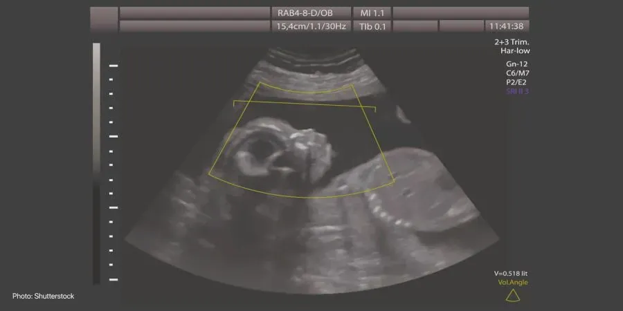 Gestational age and ultrasound data