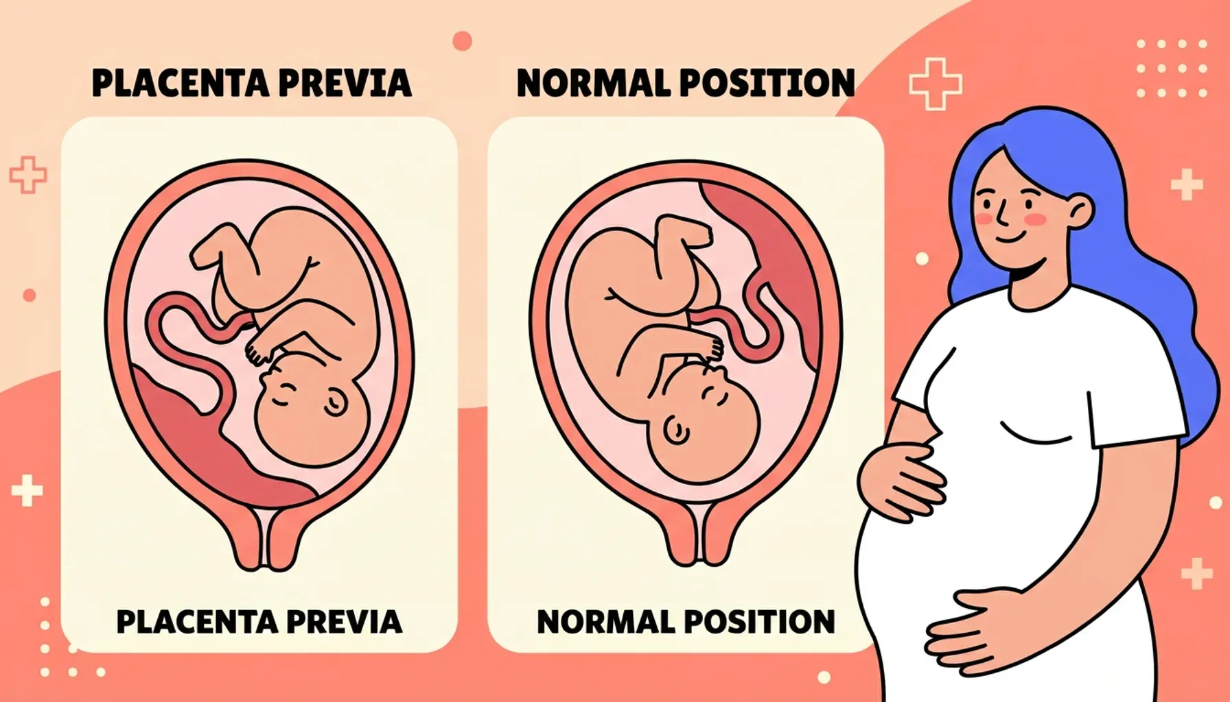 What is Placenta Previa?